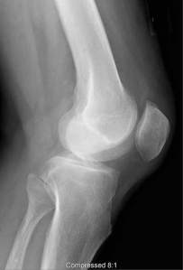 bone-xray-knee